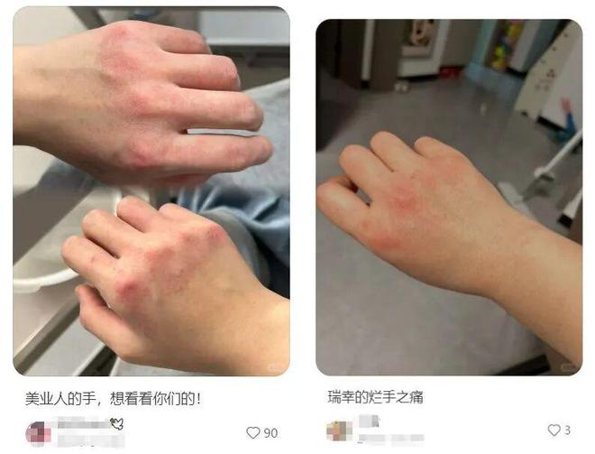 手上发红发痒脱皮只涂护手霜是不够的(图1)